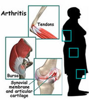 Joint Replacement – A New Life