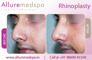 Rhinoplasty Surgery - Nose Job Mumbai - Nose Plastic Surgery India