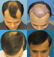 Hair Transplant in Mumbai