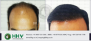 HHY Hair Transplant Clinic Offer Free Hair Consultation Worth 1500 INR