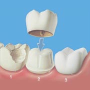 Root Canal Treatment In Pimple Saudagar Pune