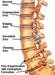 Spondylosis Treatment _Shree Ayurved Clinic