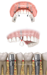 Dental Implants in Navi Mumbai | Tooth Implant Cost - Smile Evolve