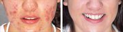 Fight Acne Issues Cost Effectively