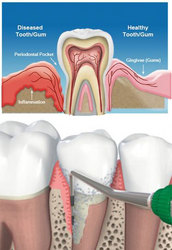 Periodontal Surgery | Gum Treatment in Navi Mumbai - Smile Evolve