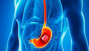 Gastrointestinal Cancer Hospital in Malad