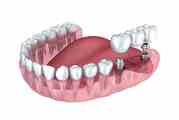 Offering Best Dental Implants in Pune