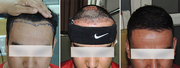 Hair Transplant in Pune- Sai Cosmetics