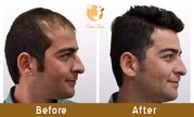 Hair transplant clinic in Andheri